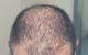 Mann mit wenig Haaren